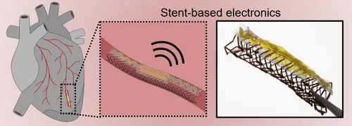 Stent-based electronics